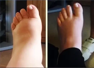 Leags-Ankles-Feet-shrink-4